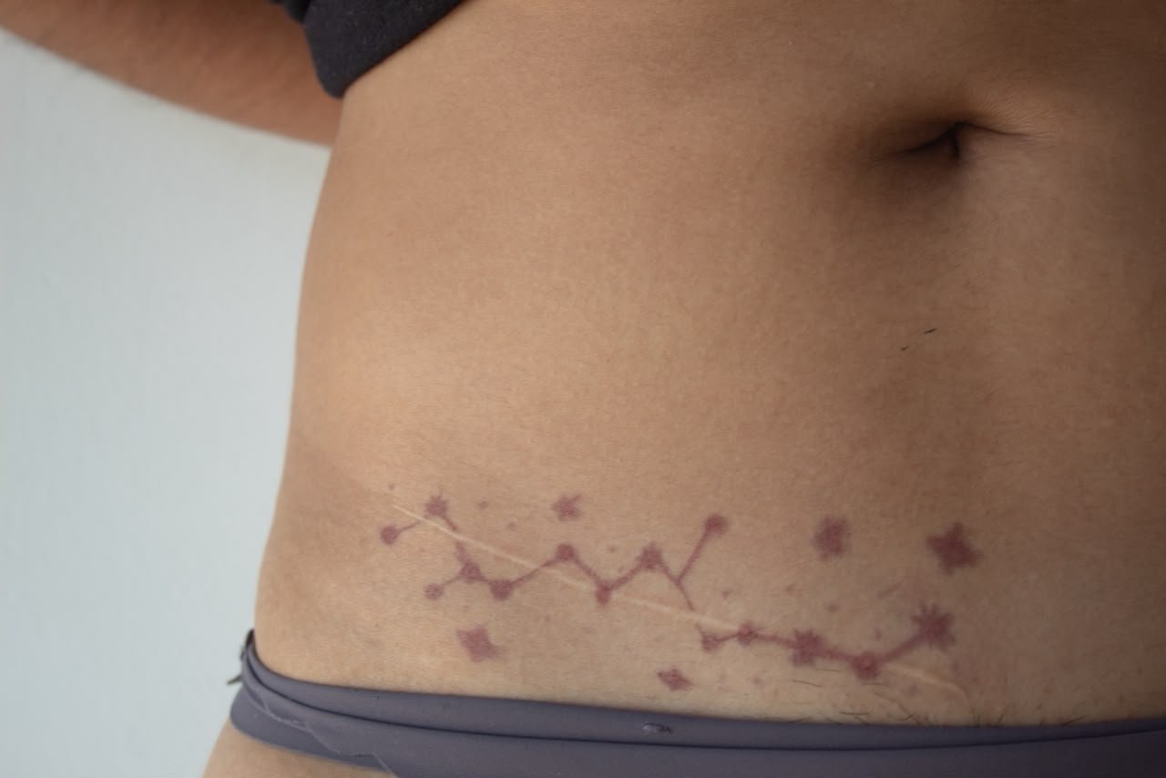 Scar marked with a hand-drawn constellation