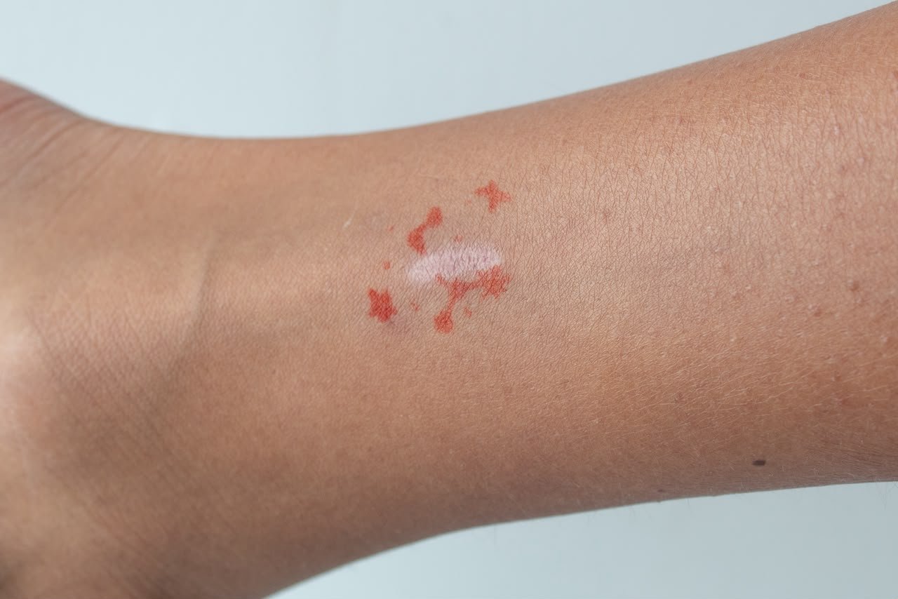 Close study of a scar on skin