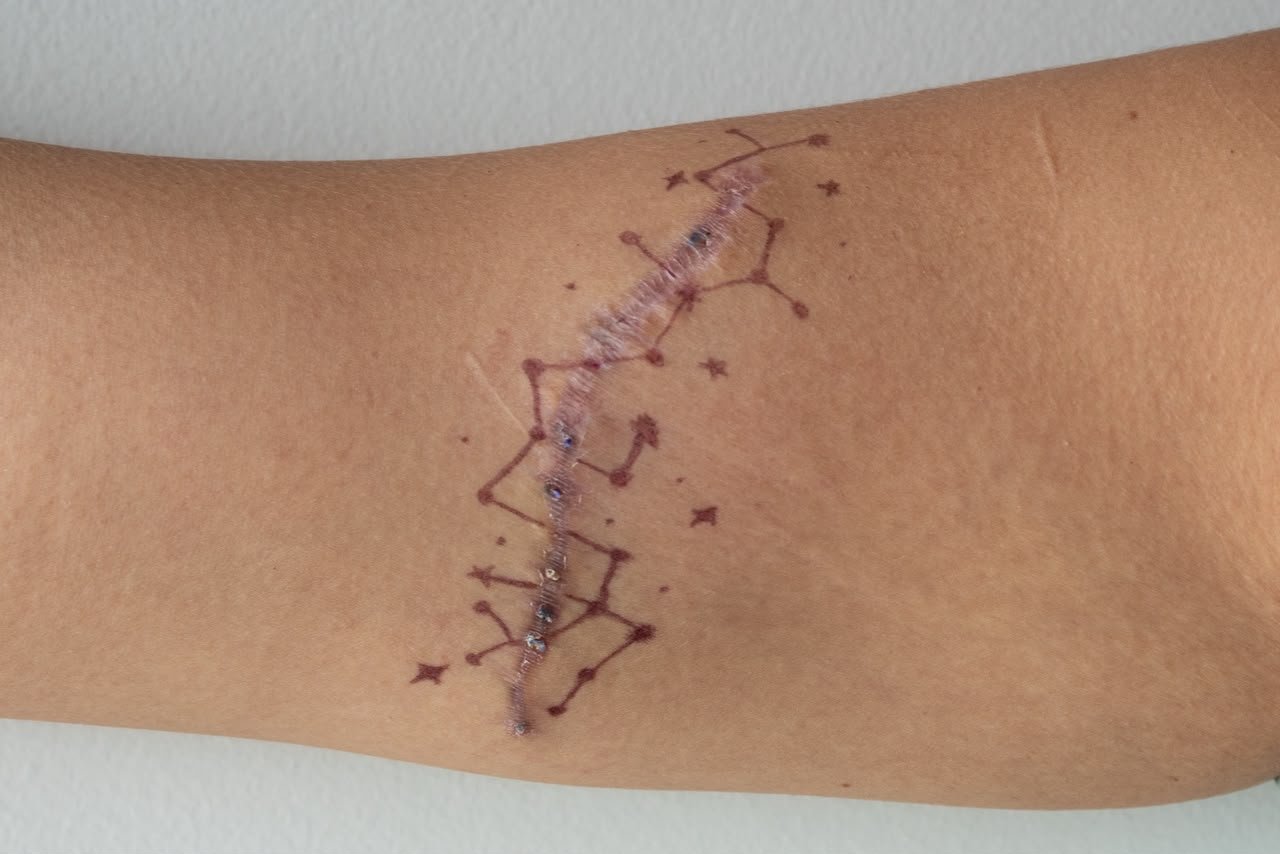 A scar traced with a constellation drawing