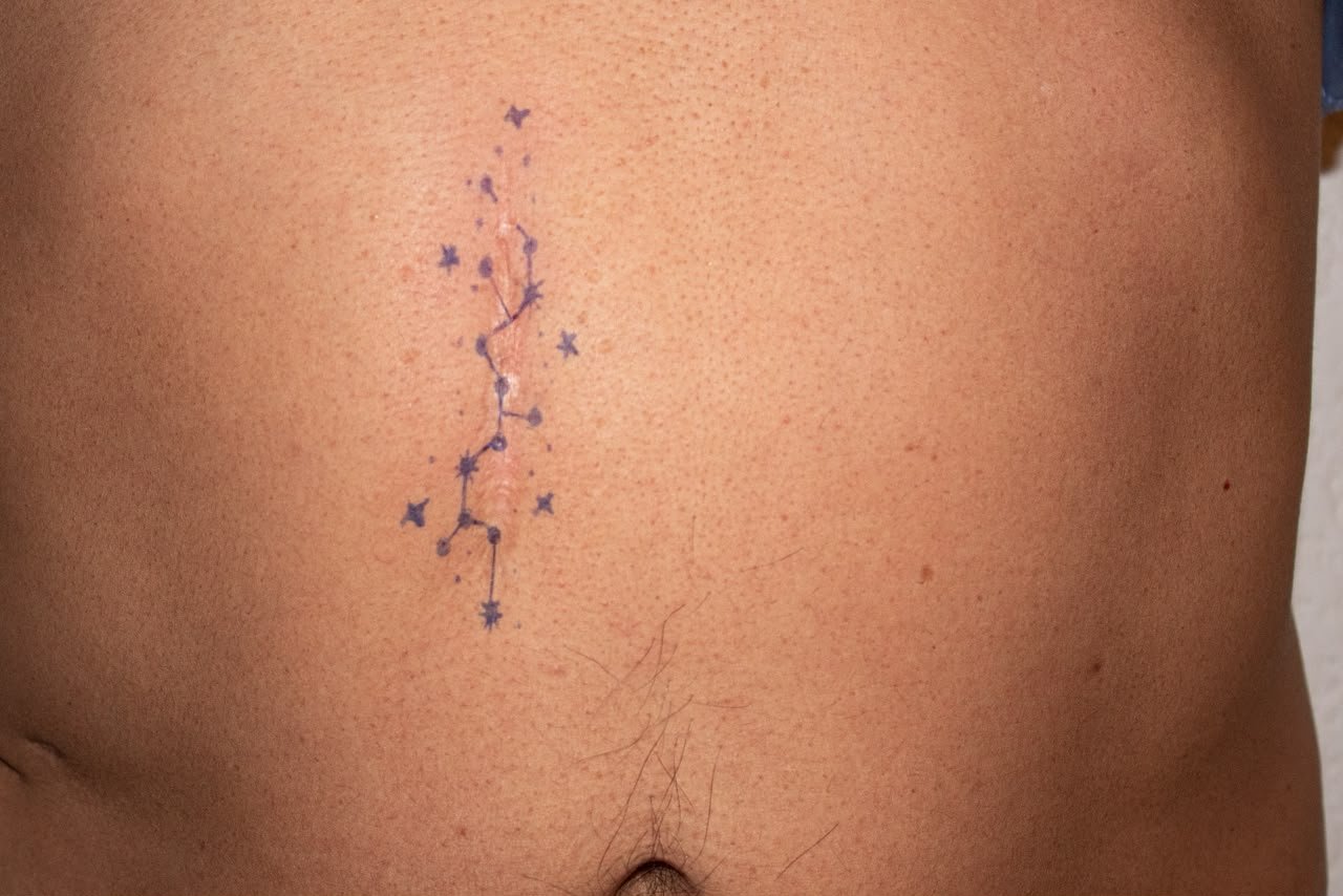 Scar study with drawing