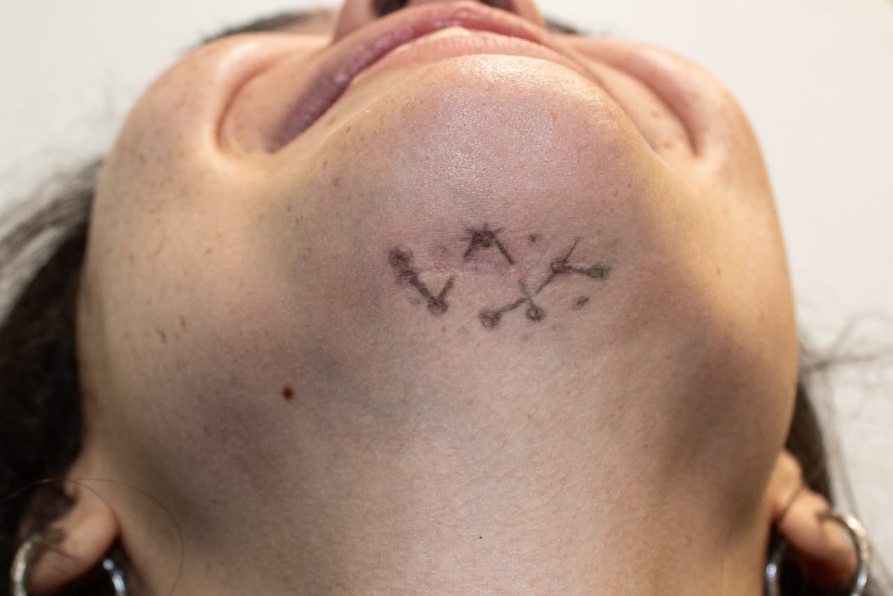 Photographic scar study