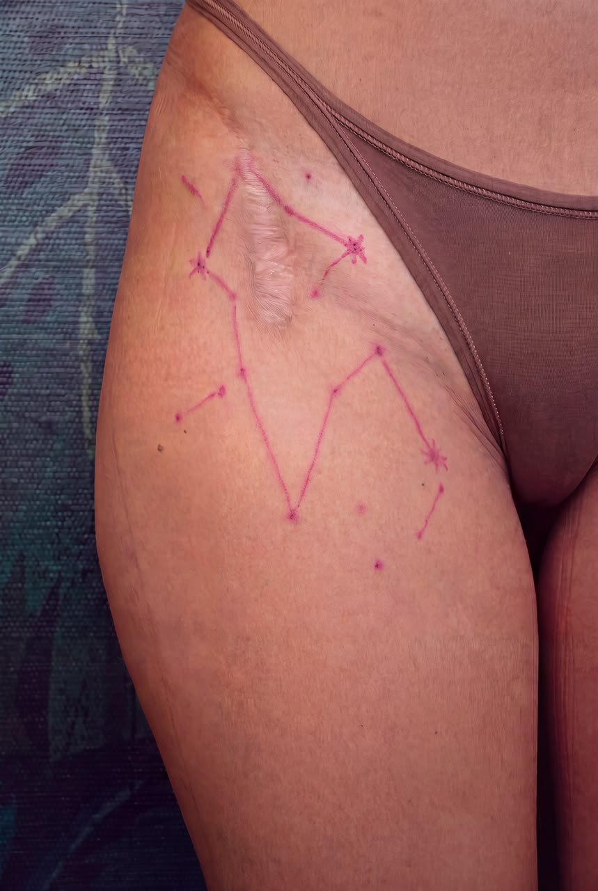 Hip scar with constellation intervention